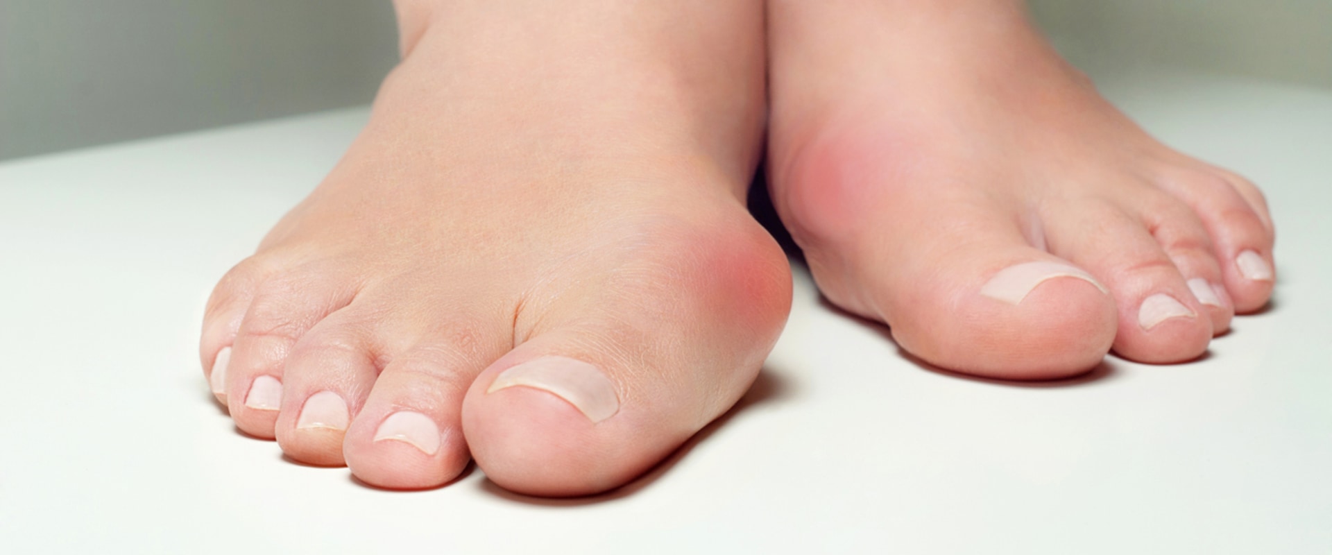 What is the most common foot anomaly?