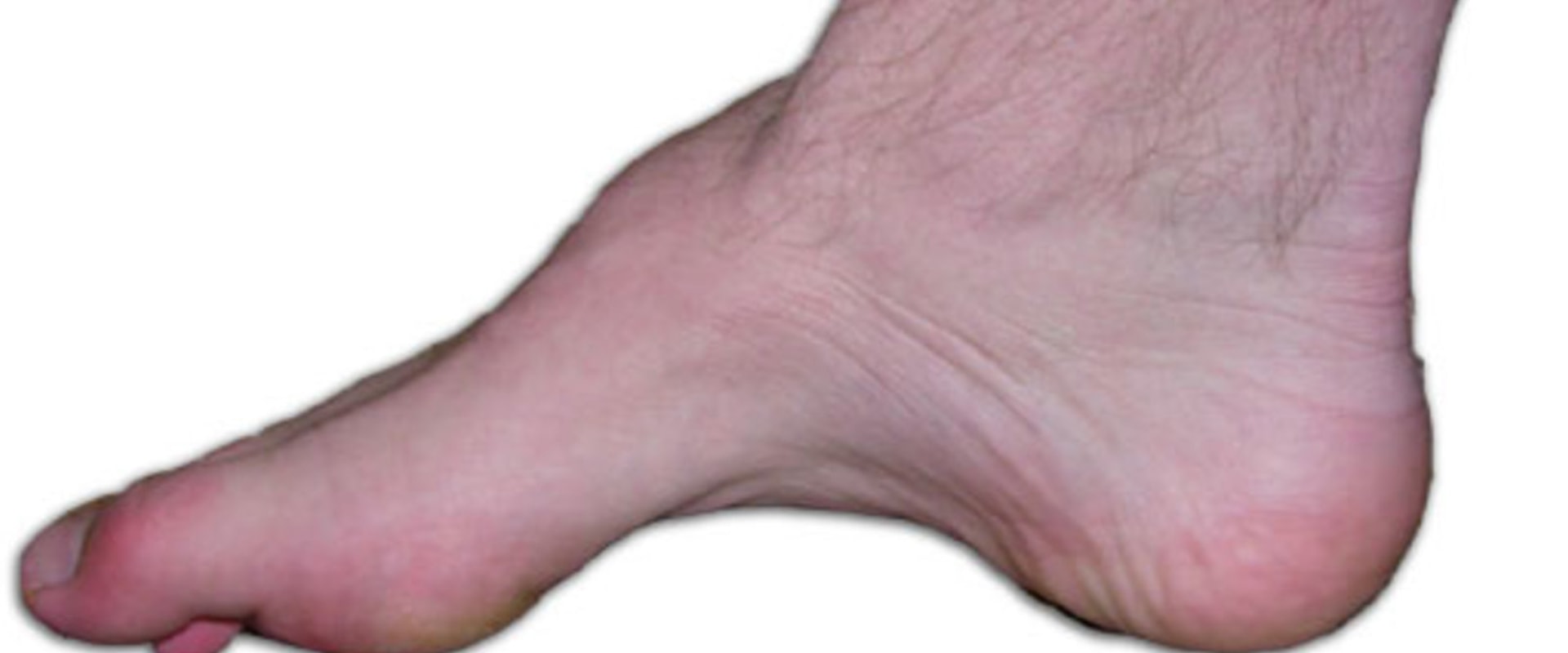 Understanding the Most Common Foot Deformities