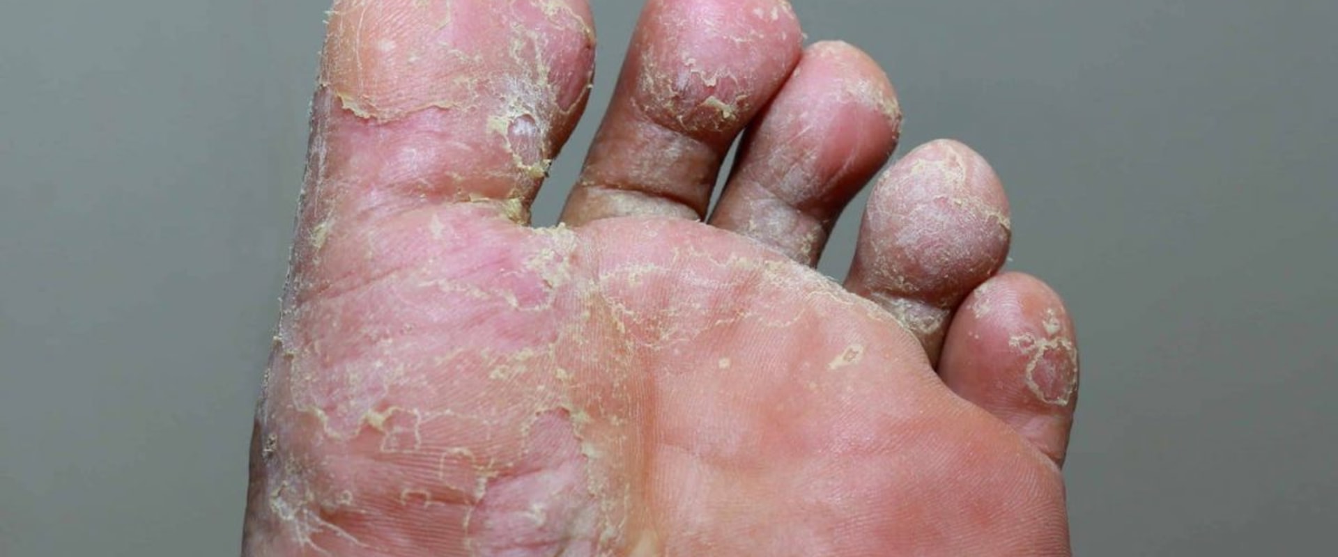 Expert Insights: Understanding Foot Diseases and Their Impact on Your Health