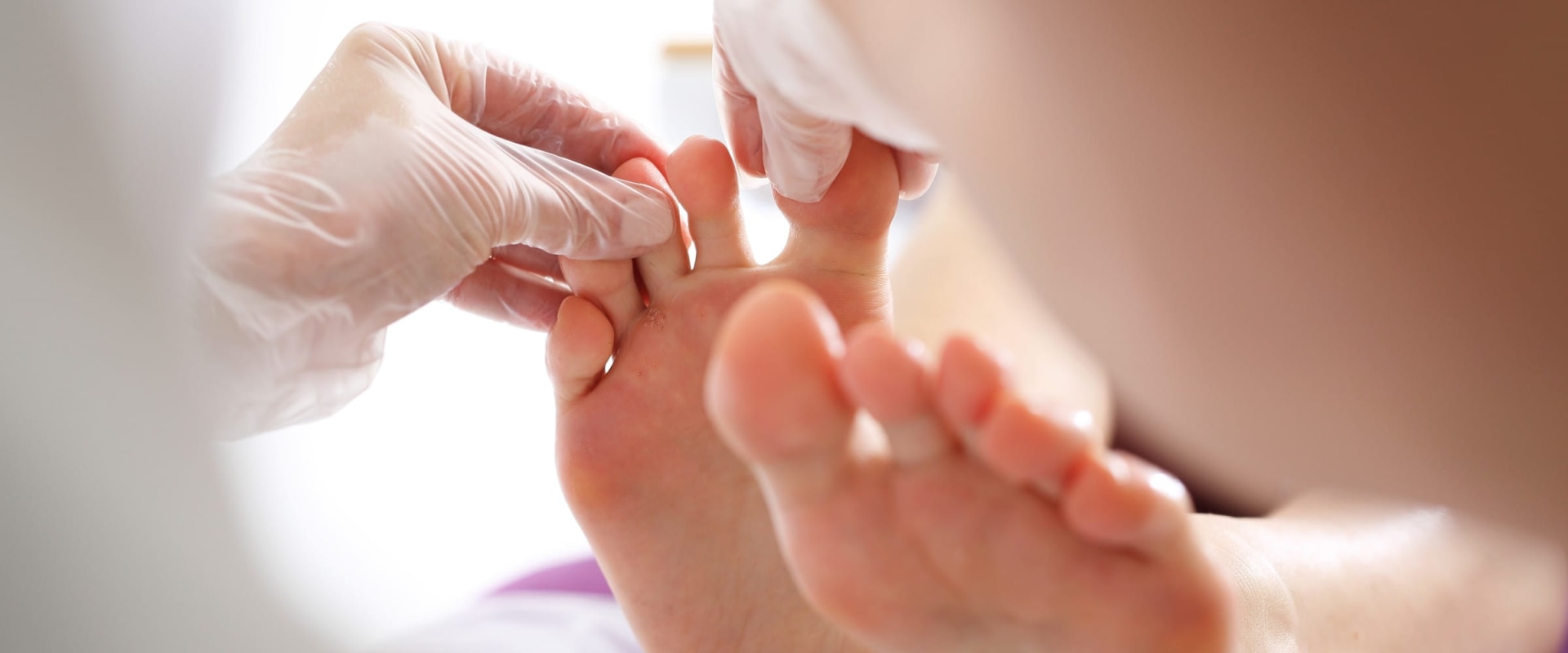 Understanding Diabetic Toenails: What They Look Like and When to Seek Help for Foot Disorders