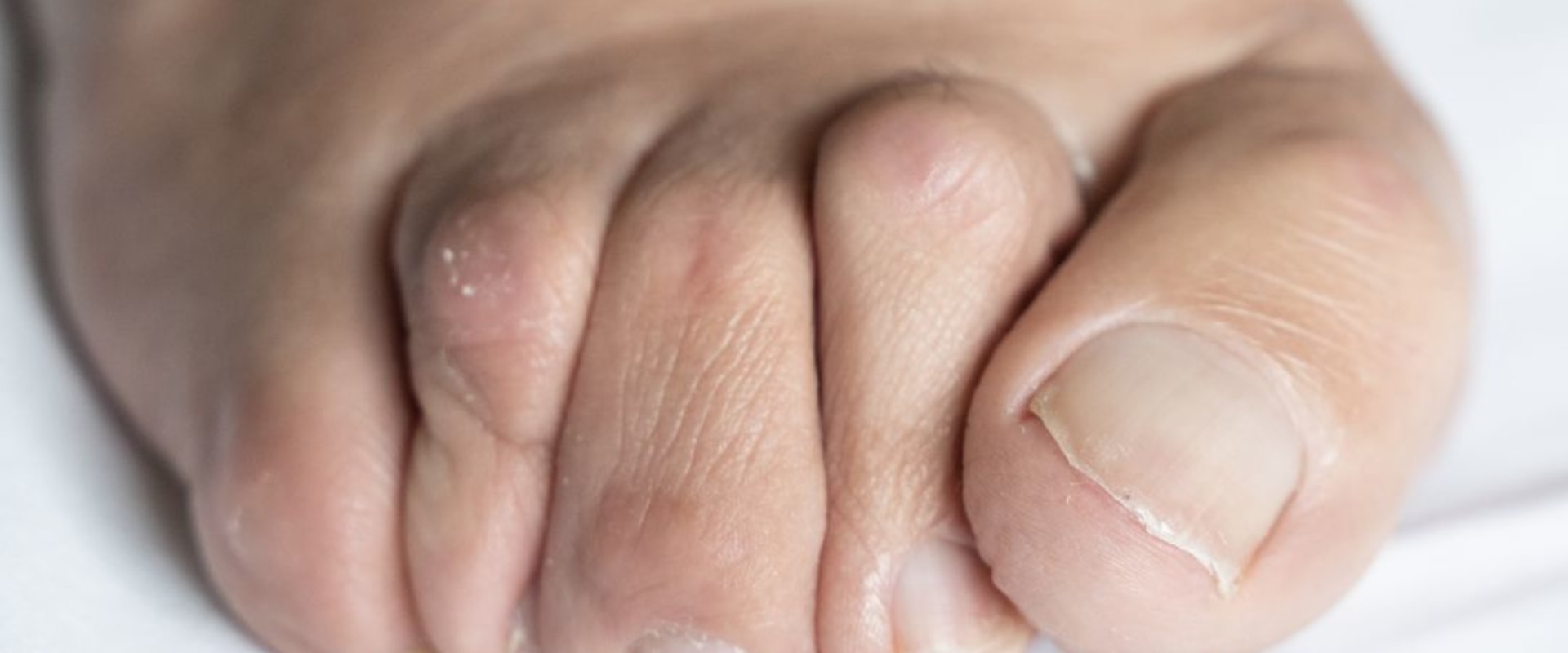 Understanding Foot Deformities: Causes, Symptoms, and Treatment