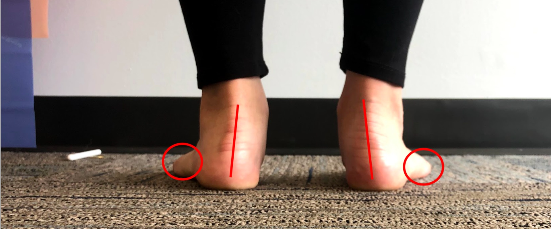 Understanding Foot Posture: An Expert's Perspective