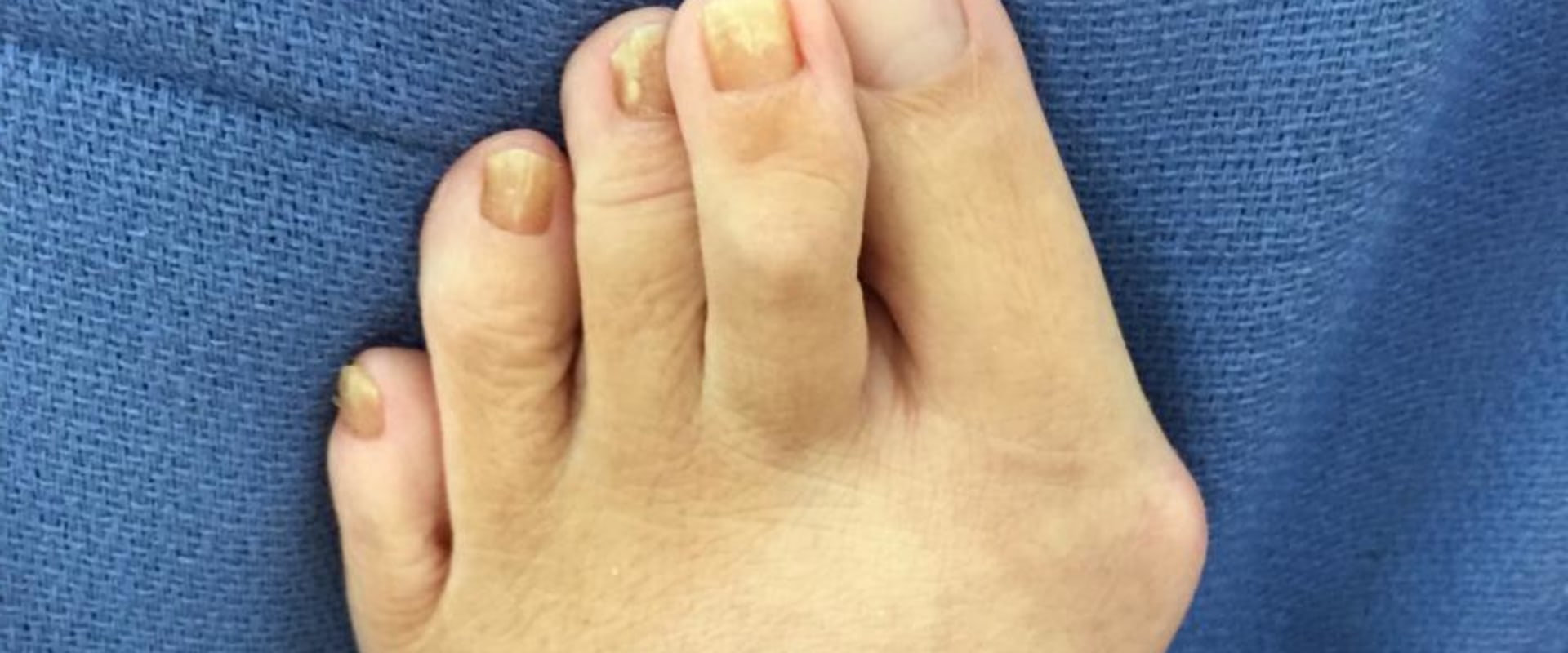 Expert Insights: Understanding and Treating Foot Deformities