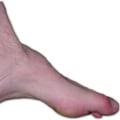 Understanding and Managing Common Foot Deformities