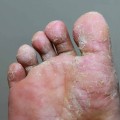 Expert Insights: Understanding Foot Diseases and Their Impact on Your Health