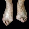 Understanding Foot Deformities in Newborns