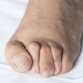 Understanding and Managing Foot Deformities