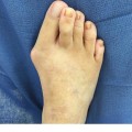 Expert Insights: Understanding and Treating Foot Deformities