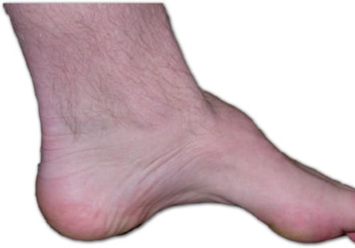 Understanding the Most Common Foot Deformities