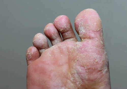 Expert Insights: Understanding Foot Diseases and Their Impact on Your Health