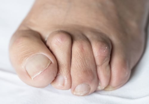 Understanding Foot Deformities: Causes, Symptoms, and Treatment