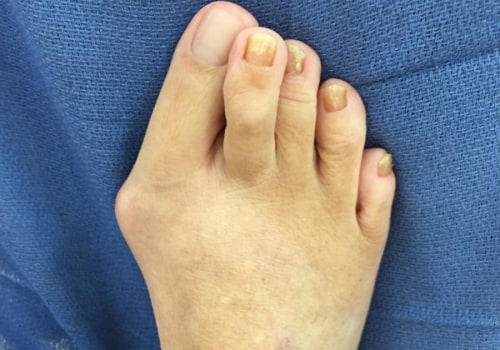 Expert Insights: Understanding and Treating Foot Deformities